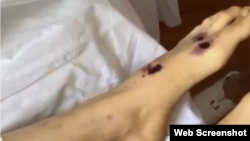 Күйеуі атпен сүйреп өлтірді делінген әйелдің денесіндегі жарақат. Суретті журналист Сандуғаш Дүйсенова желідегі парақшасында жариялады. Скриншот.
