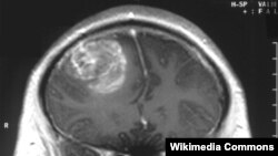 سرطان مغز در پسر ۱۵ ساله (Gliobastoma)