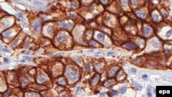 Mostër e kancerit të gjirit nën mikroskop