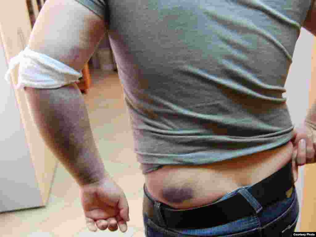 Rusija - Još jedan pretučen novinar - Novinar Maxim Zolotarev pokazuje ozljede zadobijene nakon što je pretučen od nepoznatih napadača u Moskvi.