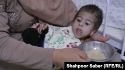 یکی از کودکان مبتلا به سوء تغذی در افغانستان 