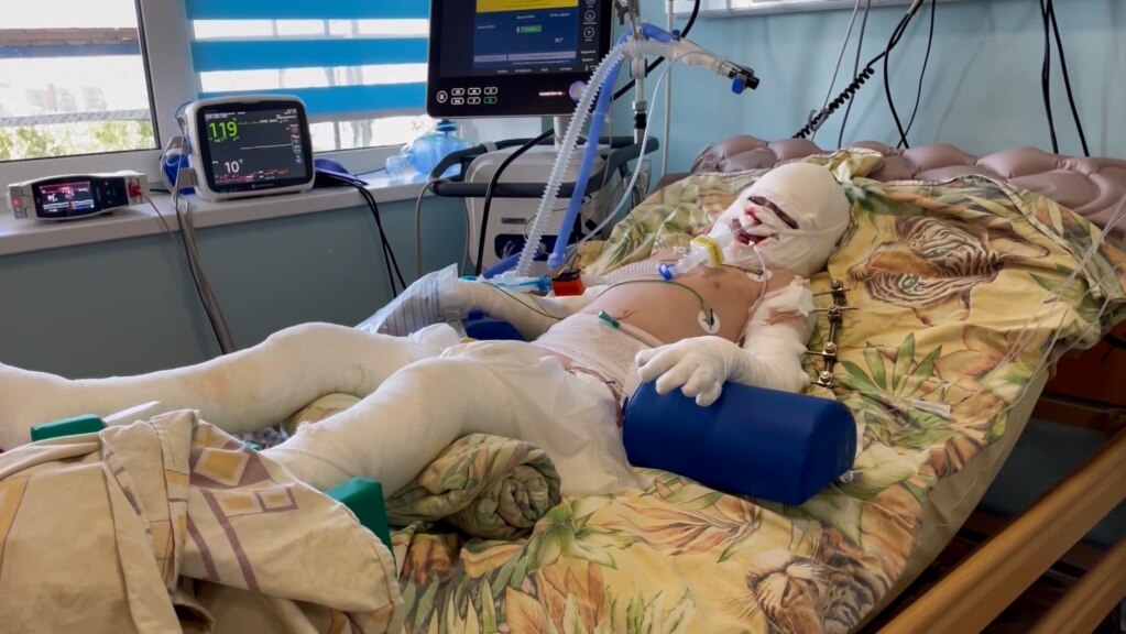 'Burns Cover 40 Percent Of His Body': Young Boy Survives Russian Attack That Killed His Mother 