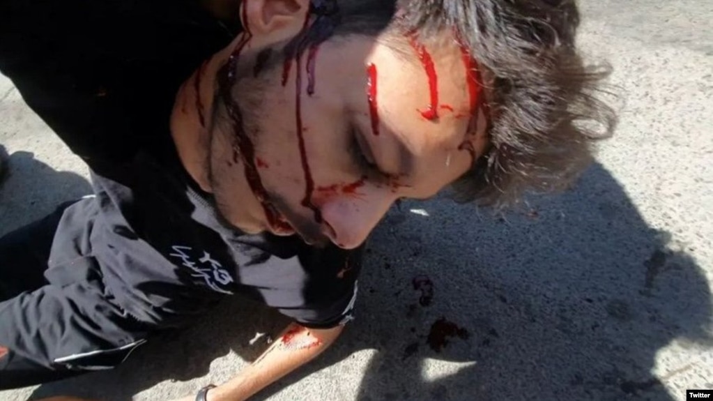 یکی از مجروحان شلیک ماموران با تفنگ‌های ساچمه‌ای به معترضان