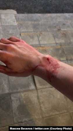 Рана на руке Максима Веселова после столкновения со сторонником голосования по поправкам к Конституции