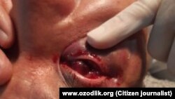 В результате нападения родственника пациента хирург Одилжон Кулдошев лишился зрения на правый глаз.