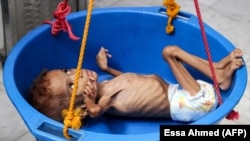 Pothranjeno dijete, Jemen