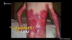 Как живут "дети-бабочки"?