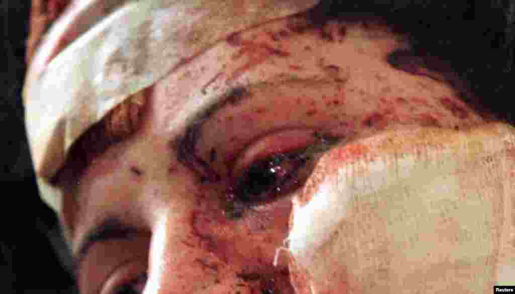 Kosovo: Albanka Safete Salihi, koja je zadobila teške povrede, fotografisana je dok je boravila u bolnici u jugozapadnom kosovskom gradu Đakovici.Ukrajina: Sergij, koji je zadobio povrede glave i izgubio prste tokom raketnog napada na svoje selo, fotografisan je na bolničkom krevetu u Čuhuivu, blizu Harkiva u Ukrajini.