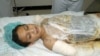 12-летний Али Исмаил Аббас – жертва американских бомбардировок в Ираке – на обследовании в больнице в Кувейте 16 апреля 2003 года 