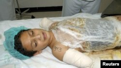 Ali Ismail Abbas was 12 when he lost both arms and suffered burns to most of his body as a result of a U.S. bombing attack. Abbas is seen here being examined by doctors at Ibn Sina Hospital's Burn Center in Kuwait in April 2003.