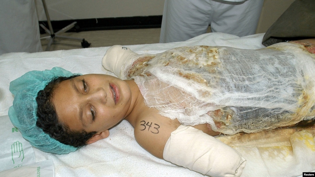 Ali Ismail Abbas was 12 when he lost both arms and suffered burns to most of his body as a result of a U.S. bombing attack. Abbas is seen here being examined by doctors at Ibn Sina Hospital's Burn Center in Kuwait in April 2003.