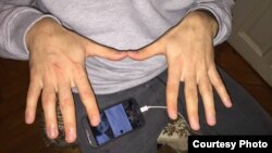 Mehman Hüseynov. İşgəncə izləri. 11yan2017