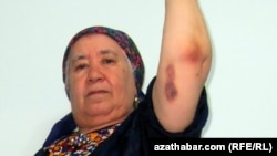 RFE/RL Turkmen Service correspondent Soltan Achilova, showing bruises suffered during a late-October attack in Ashgabat.