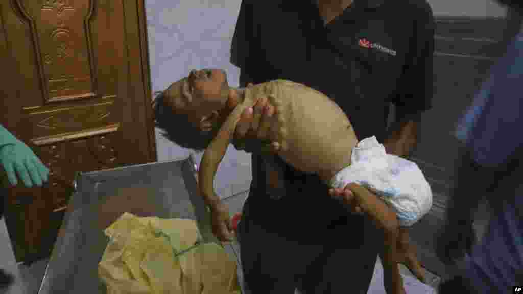 „A legsúlyosabb humanitárius katasztrófának vagyunk szemtanúi, amit valaha is láttunk” - mondta Jeanette Bailey, a New York-i székhelyű segélyszervezet, az International Rescue Committee gyermektáplálkozási vezetője. Az AP fotóján az ötéves, éhhalált halt Jamal al-Najjar