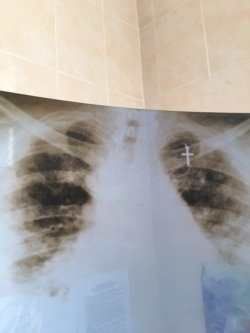 Знімок легень пацієнта із коронавірусом