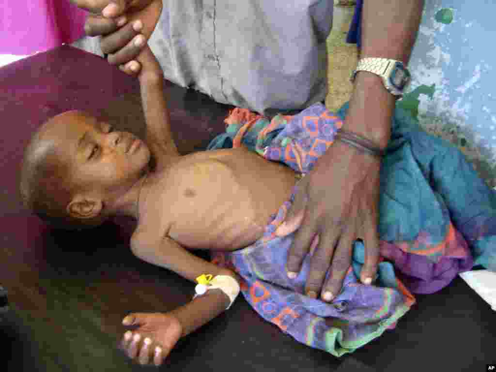 Nune Abdil, aged 2, a malnourished child from southern Somalia, receives treatment in Mogadishu on July 16 amid the worst drought in eastern Africa in seven decades. Photo by Farah Abdi Warsameh for AP