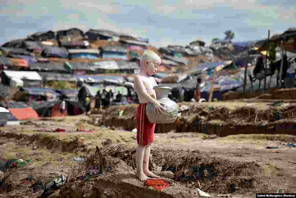 An albino Rohingya refugee poses for a picture in Cox's Bazar, Bangladesh. (Reuters/Cathal McNaughton)