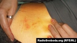 An image released by ombudsman Nina Karpachova after she visited Yulia Tymoshenko, showing bruises on her abdomen