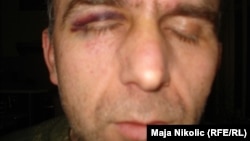Aleksandar Ninković nakon zlostavljanja u policiji