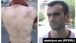 Armenia- Andranik Aslanian, an opposition activist who claims to have been beaten by police, 19Jul2016.