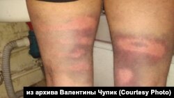 Травмы задержанных в Хабаровске