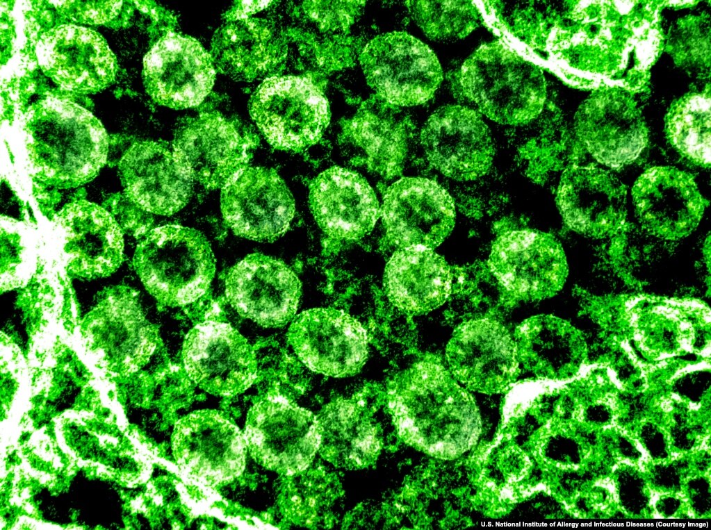 Скупчення віріонів SARS-CoV-2, яке видно через електронний мікроскоп. Віріони коронавірусу за допомогою шипів на своїй поверхні прикріплюються до рецепторів у деяких клітинах людського організму – особливо в легенях – і проникають потім всередину клітини