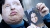 Iran Victim Backs 'Eye-For-Eye' Blinding
