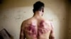 Следы пыток на теле бывшего заключенного сирийской тюрьмы 