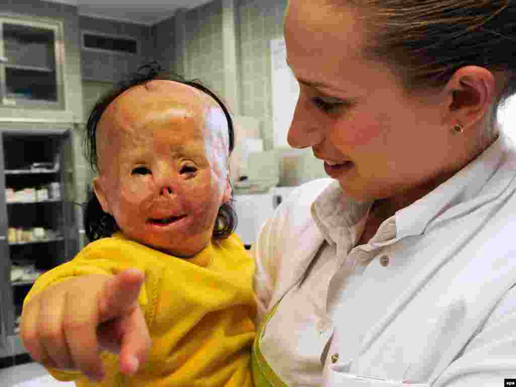 A doctor holds a 2-year-old Iraqi girl, Maryam, who was severely burned in a fire. An aid group transported Maryam to Germany for surgery, enabling her to eat and speak again, and she is now set to return to her family. Photo by Angelika Warmuth for epa