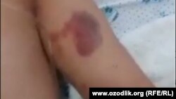 Телесные повреждения на теле жителя Андижана А. Абдукаримова. Кадр из видеозаписи.