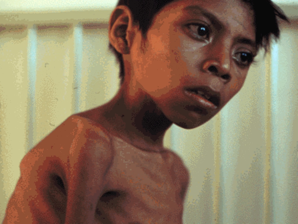 Afghanistanski dječak obolio od tuberkuloze, 24.03.2010. 