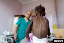 Ребенок в иностранной больнице в столице Йемена Сане. Октябрь 2018 года