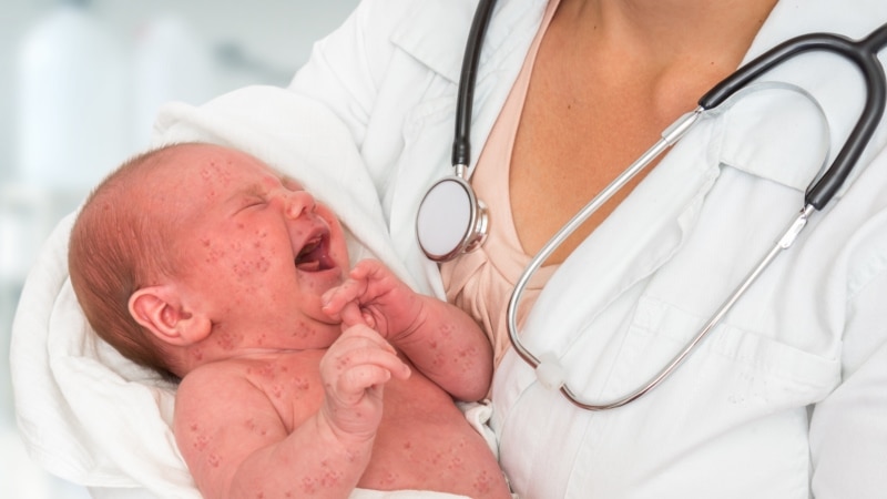 Нови шест случаи на морбили, меѓу кои и бебе од месец ипол 