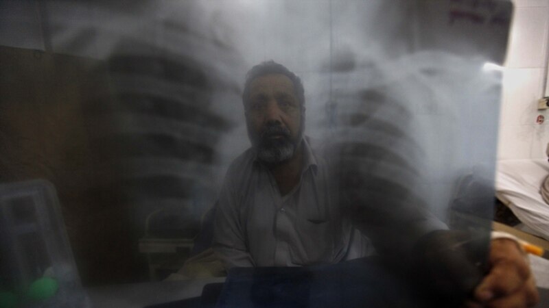 MSF: سالانه حدود ۶۰ هزار افغان به توبرکلوز مبتلا می‌شوند