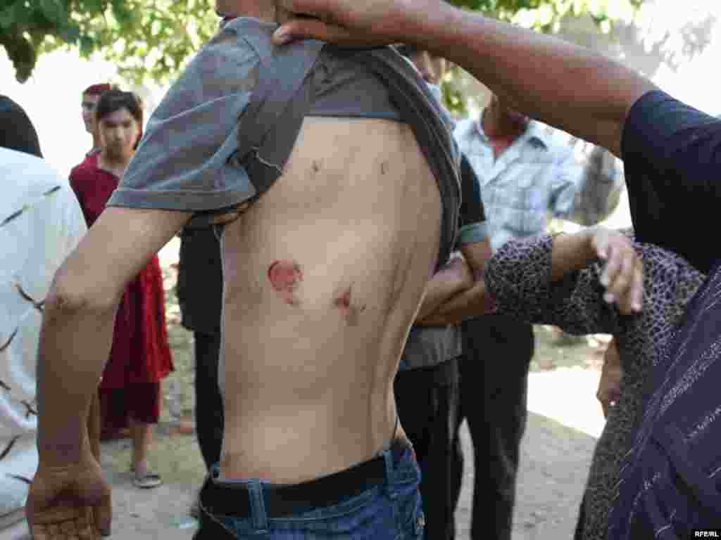 A young man from Nariman shows the wounds he says he received at the hands of security forces during the raid. - Photo by Bruce Pannier