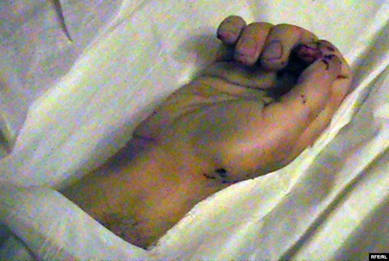 Правая рука Азамата Каримбаева с колотыми ранами. Его жена утверждает, что это – следы пыток. Поселок Шубарши, 27 декабря 2009 года.