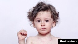 Az ENSZ és a WHO attól tart, hogy a Covid elleni karanténok és intézkedések közepette járványos gyermekbetegségek ütik fel a fejüket