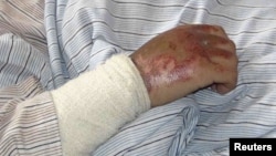 Рука жертвы нападения с обливанием кислотой. Иллюстративное фото.