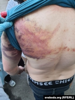 Сліди побиття на спині одного з затриманих після президентських виборів у Мінську