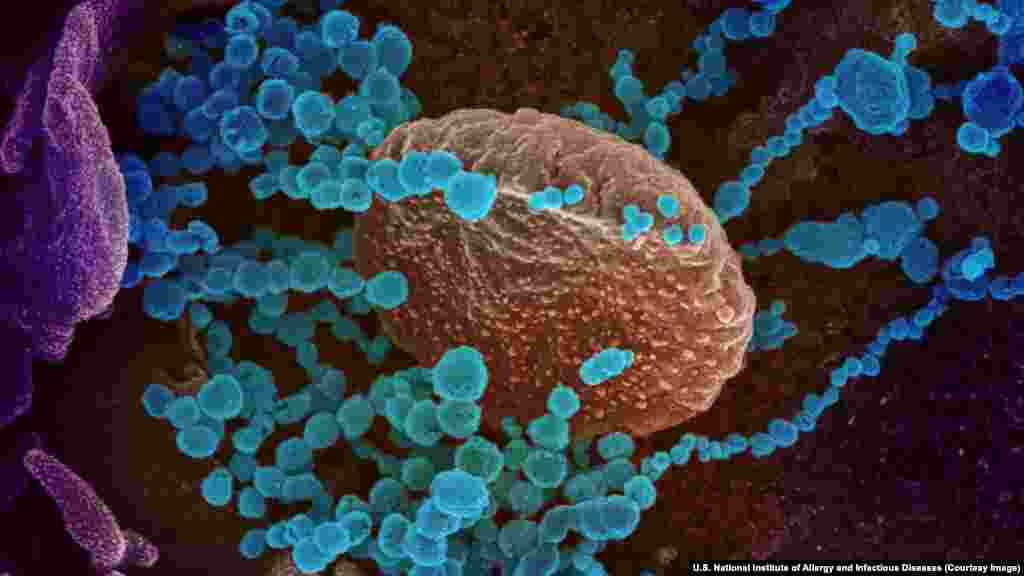 Вирионы SARS-CoV-2 разрастаются в клетке человеческого организма. Все фотографии в этой галерее раскрашены с использованием специальных программ и Photoshop