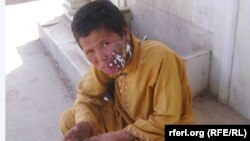 د افغانستان په جوزجان کې د لشمینیا یو ناروغ. ۲۰۱۳م کال