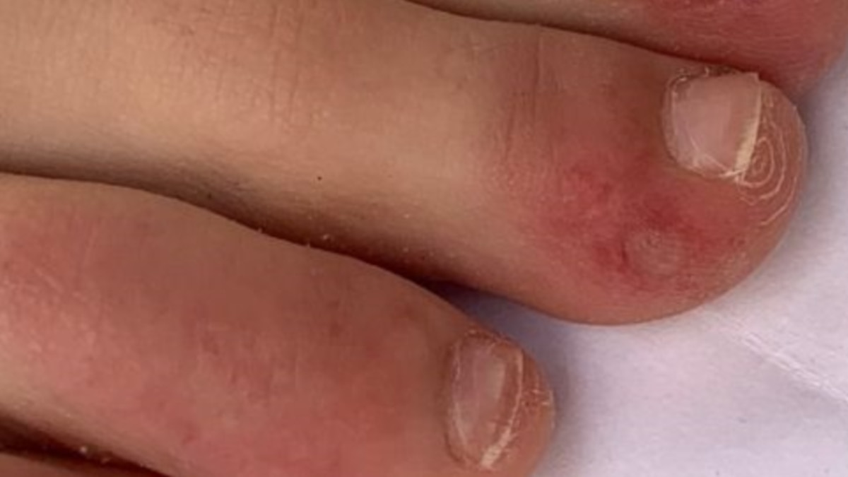 Semne si simptome ale bolii venoase cronice - Erupție cutanată pe picioare în varicoză