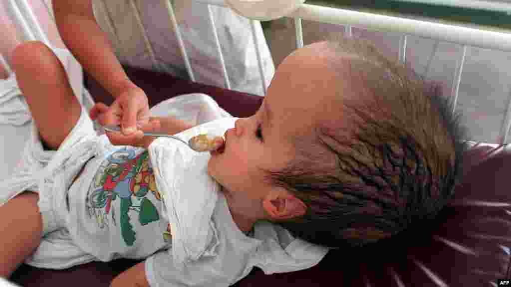 Двухлетняя девочка с увеличенной головой, рожденная после воздействия синтетической смеси &quot;Агента Оранжа&quot;, в госпитале во вьетнамском городе Хошимин в 1998 году.
