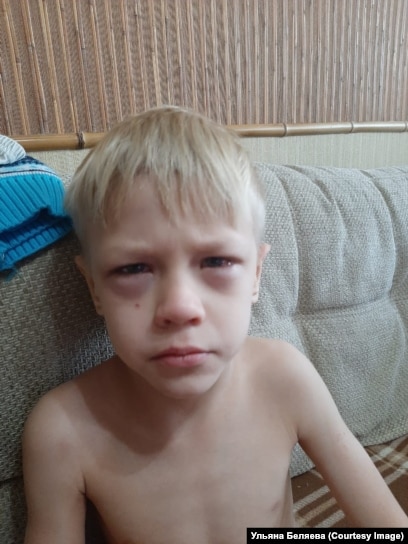 Ребенок задыхался и синел на глазах. Во многих регионах России из аптек  исчез жизненно важный препарат Преднизолон