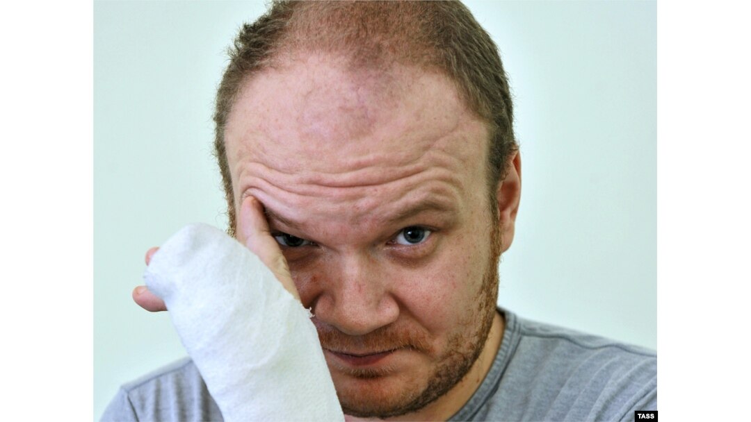 Oleg Kashin spent months recovering from the attack.