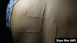 Bohdan Serhiyets spent only 10 hours in captivity in May 2014, but in that time Russia-backed separatists carved a swastika on his back and pulled out two of his fingernails. Serhiyets remembers his torturers saying they shouldn’t let him out alive so no one could see what they had done to him.