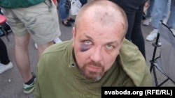 Следы побоев у освобожденного протестующего. Минск, 14 августа 2020 года