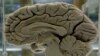 Brain Injuries Dementia