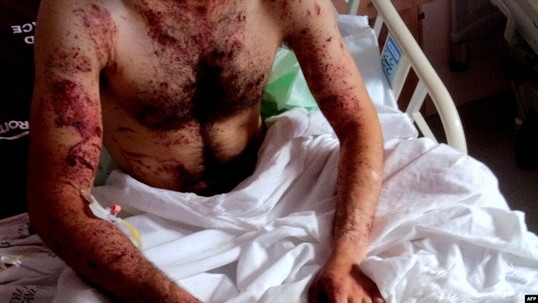مردی که پس از گریز از سرکوب‌های تظاهرات در سوریه در بیمارستانی در استان مرزی ختای ترکیه به‌سر می‌برد. ۸ ژوئن ۲۰۱۱.