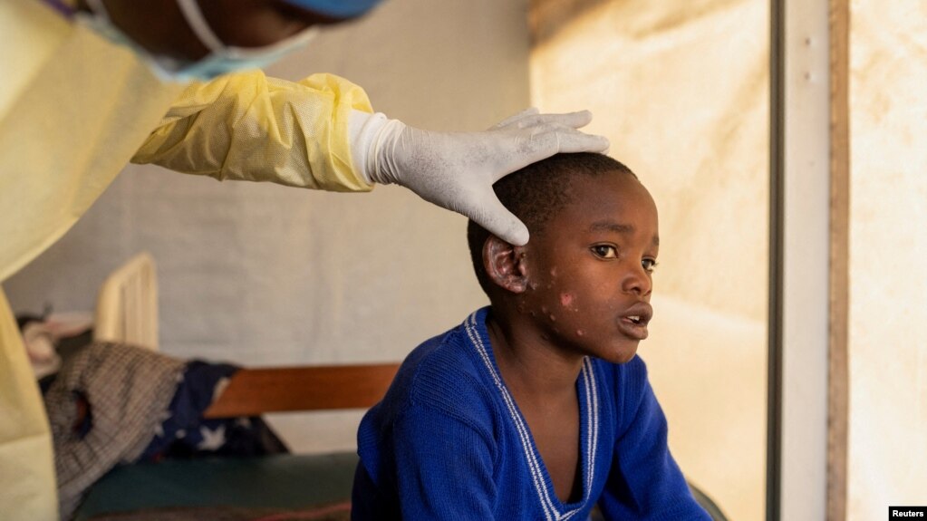 یک کودک مبتلا «آبله ام» در کنگو